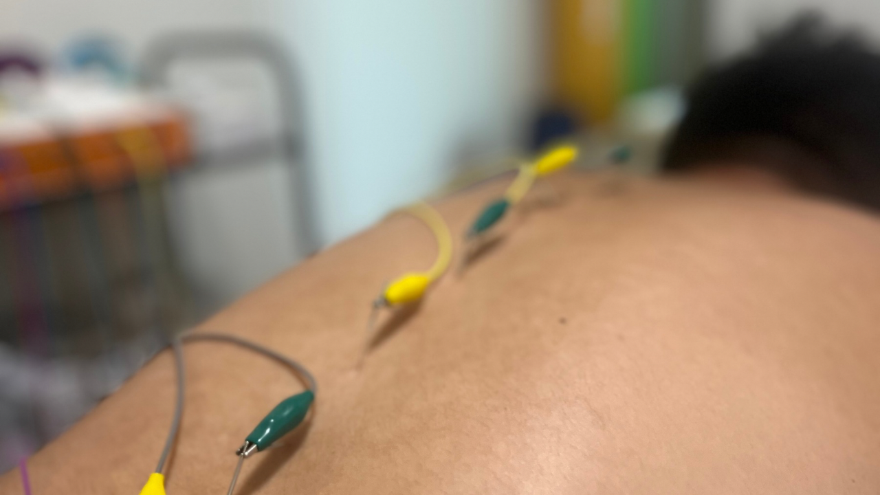 背中への鍼通電治療の様子